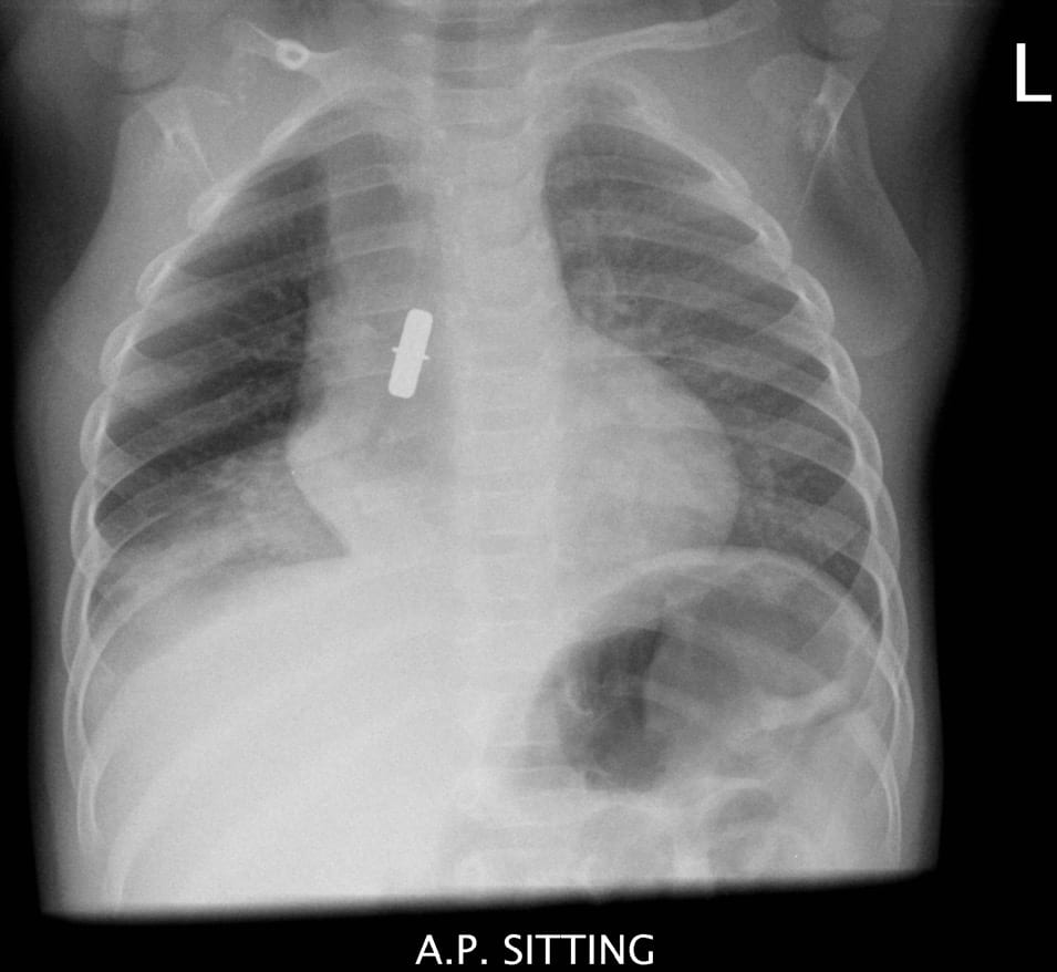 Foreign body inhalation_Table Image 1 Foreign body inhalation_Table Image 1
